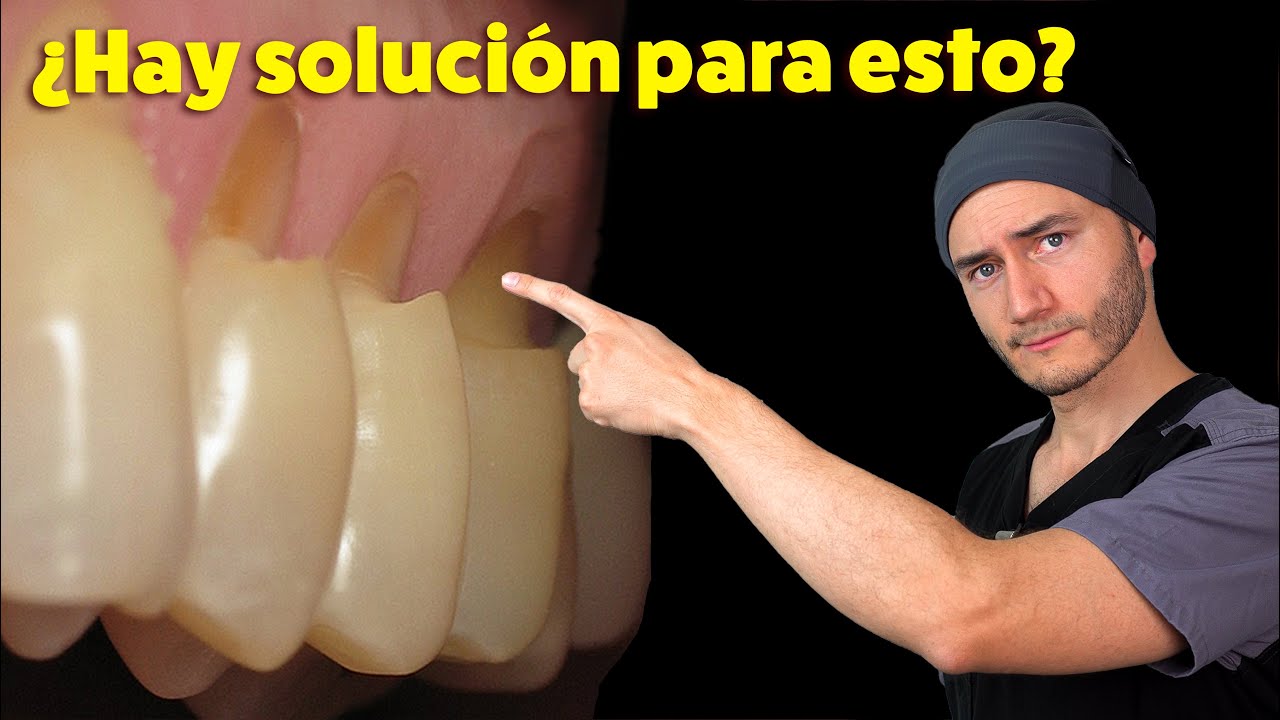 Desgastes en el cuello de los dientes | Causa y Solución | Abfracción Dental