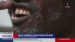 México confirma 49 casos de viruela del mono y emite aviso epidemiológico….08-18-2024