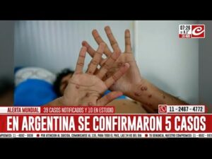 Preocupación mundial por brote de viruela del mono: ¿cómo se evita el contagio?….08-16-2024